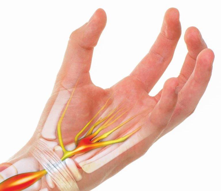 Немеют и болят кисти рук | сеть клиник «здравствуй!»